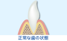 正常な歯の状態