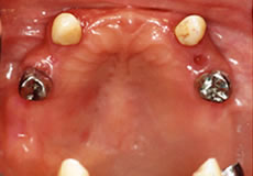 歯を部分的に数本失われた方（施術前）