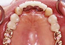 歯を部分的に数本失われた方（施術後）